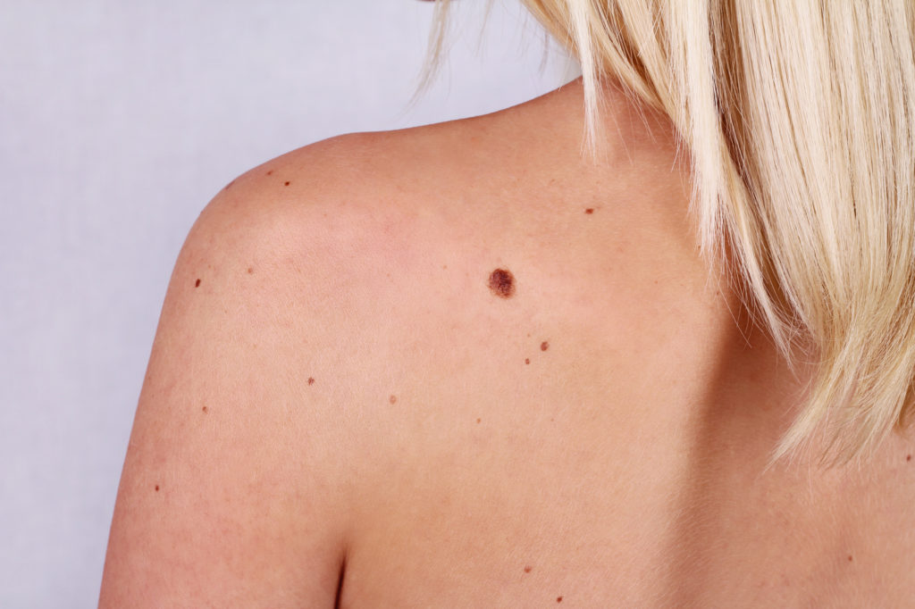 Skin Tag Removal